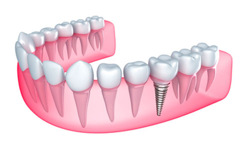 Dental Implants versus Root Canal